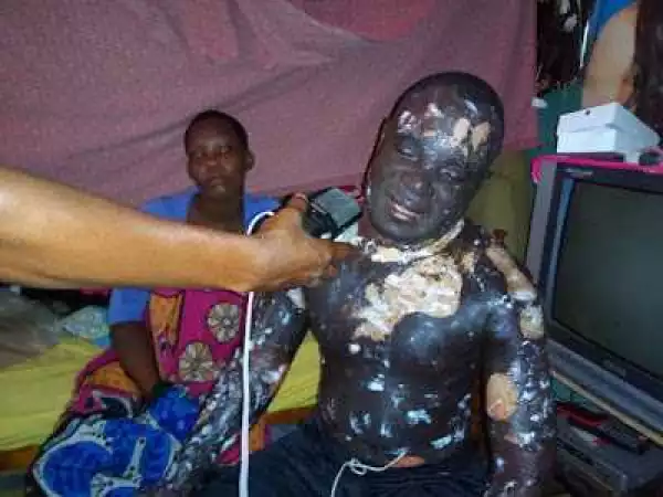 Woman Escapes After Pouring Hot Oil On Husband For Allegedly Cheating ( Graphic Photos)
